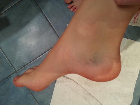Die Invalidität bei der Thrombophlebitis tiefer Venen der unteren Gliedmaßen