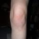 Arthrose mit 19?