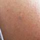Kleiner grünlicher Fleck auf der Haut, was kann das sein?