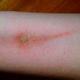 bleistift in den arm