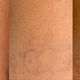 Wie viel kostet tattoo weglasern??
