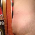 40Kg abgenommen in 2 Jahren. Ist das überschüssige Haut? (Bild)