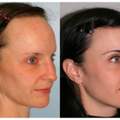 ab wieviel jahren darf man "Hairline Lowering" machen in amerika?