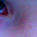 Adern im Auge rot! Woher kommt das und was tun ?   DRINGEND