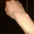 arm nach sturz angeschwollen