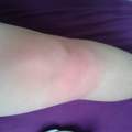 Auf Knie gefallen nach 2 Stunden immernoch Rot und Geschwollen. :(