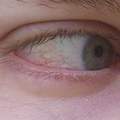 Augenproblem, trockenes Auge? Augenarzt meint nein.