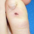 bläuliche Verfärbung des großen Zehnagels und seltsamer Leberfleck am Fuß, brauch dringend Rat!!