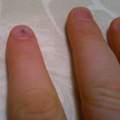 Bleistiftmine unterm Fingernagel?!? (mit Bild)