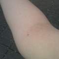 Blutpünktchen am Arm.