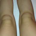 borreliose knie