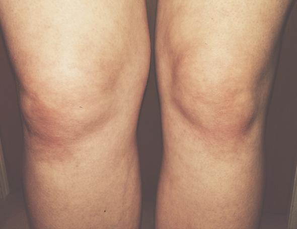 Mal de genoux - Forum SEP BY SEP (Sclérose en plaques)