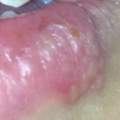 Erkältet seit 4 Tagen und jetzt eine Blase auf der Lippe