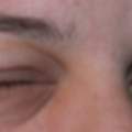 exem von allergie