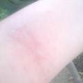 exem von allergie