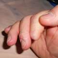 Extrem trocke  Haut an Fingern und Zehen