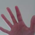 Finger gebrochen/ verstaucht? Erfahrungsberichte?