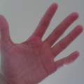 Finger gebrochen/ verstaucht? Erfahrungsberichte?