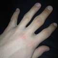 Finger knacken -Auswirkung- dicke Finger siehe Bild