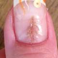 Fingernagel gespalten!