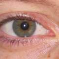 Frage zu Augenfarbe, Zentraler Iris-Heterochromie, Kurzsichtigkeit