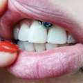 gibt es verschiedene größen bei lippenbändchen piercings??