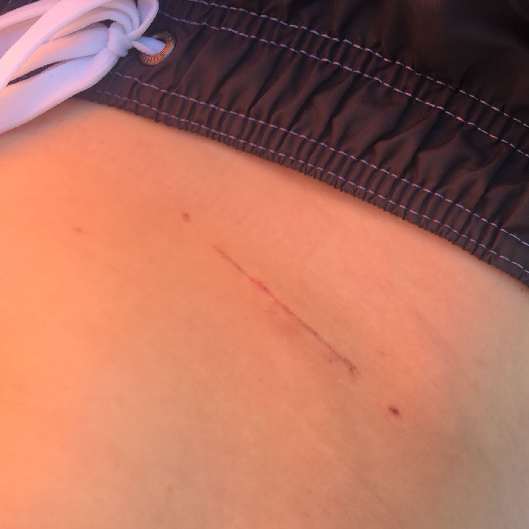 Blinddarm - .:Medizin für Kids:. Bibliothek / Er bildet sozusagen den anfangsteil des blinddarms.