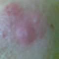 Gürtelrose oder doch Rosacea?