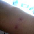 habe eine frage zu surface piercing narben?