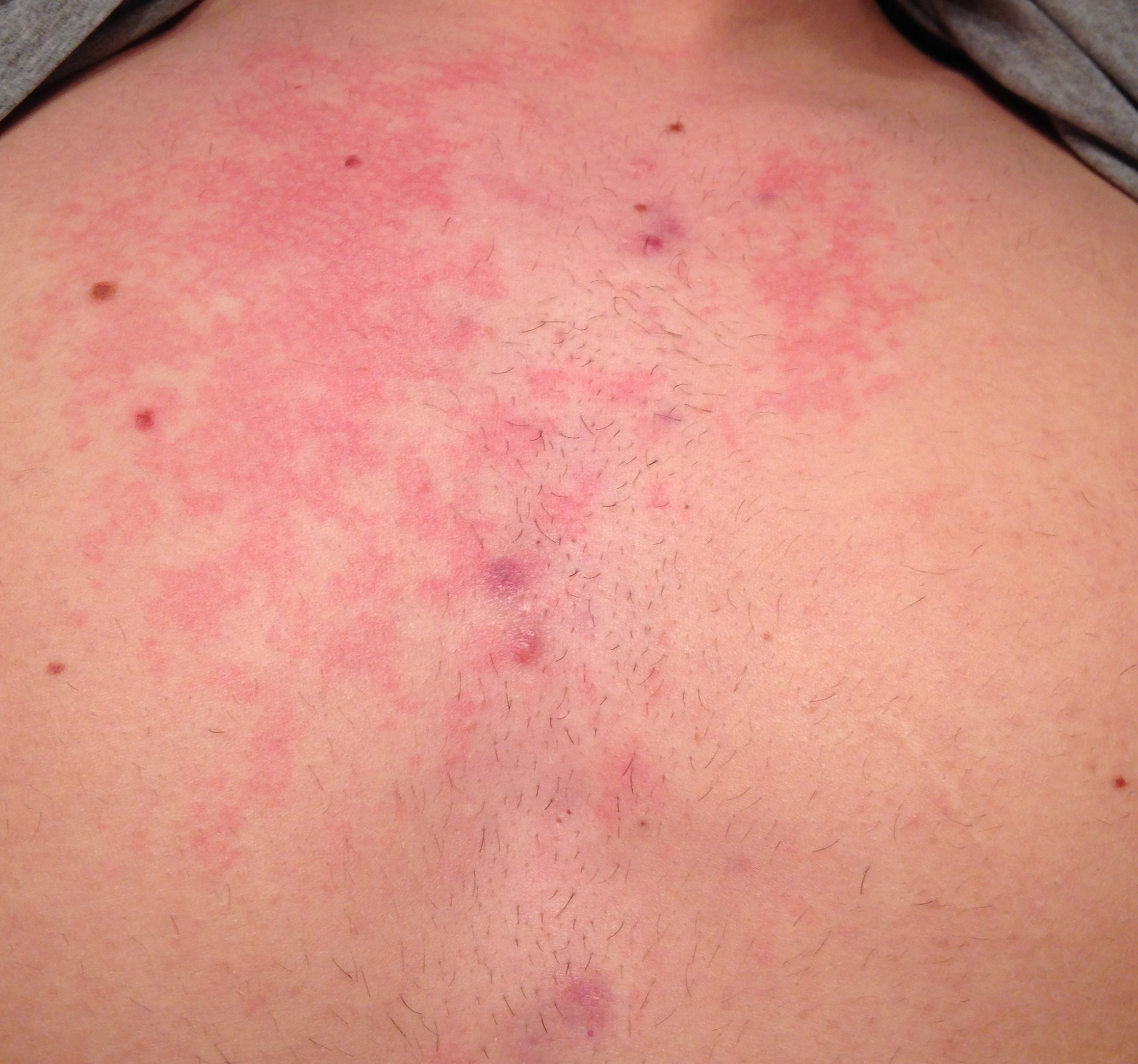 Pickel im gesicht sommer zu viele pickel im gesicht