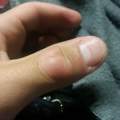 (Haut reißt, schmerz)Möchte Hautgeschwülz an Hand entfernen lassen, welche Klinik?