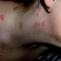Hautausschlag ? Virus ? Infektion ? Hilft mir bitte