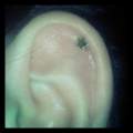 Helix, oder doch outer conch?