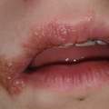 Herpes geht nicht weg ;( ?!?!
