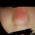 hilfe gegen grosses herpes