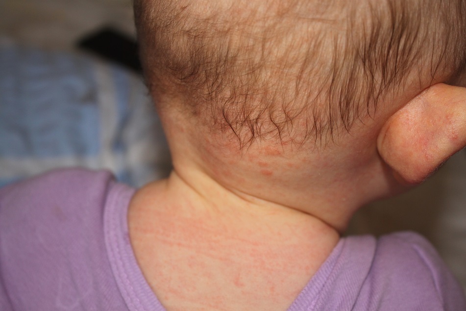 Juckende pusteln im gesicht und hals pickel im gesicht nach fieber