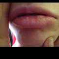 Ist das Herpes? Bitte helft mir