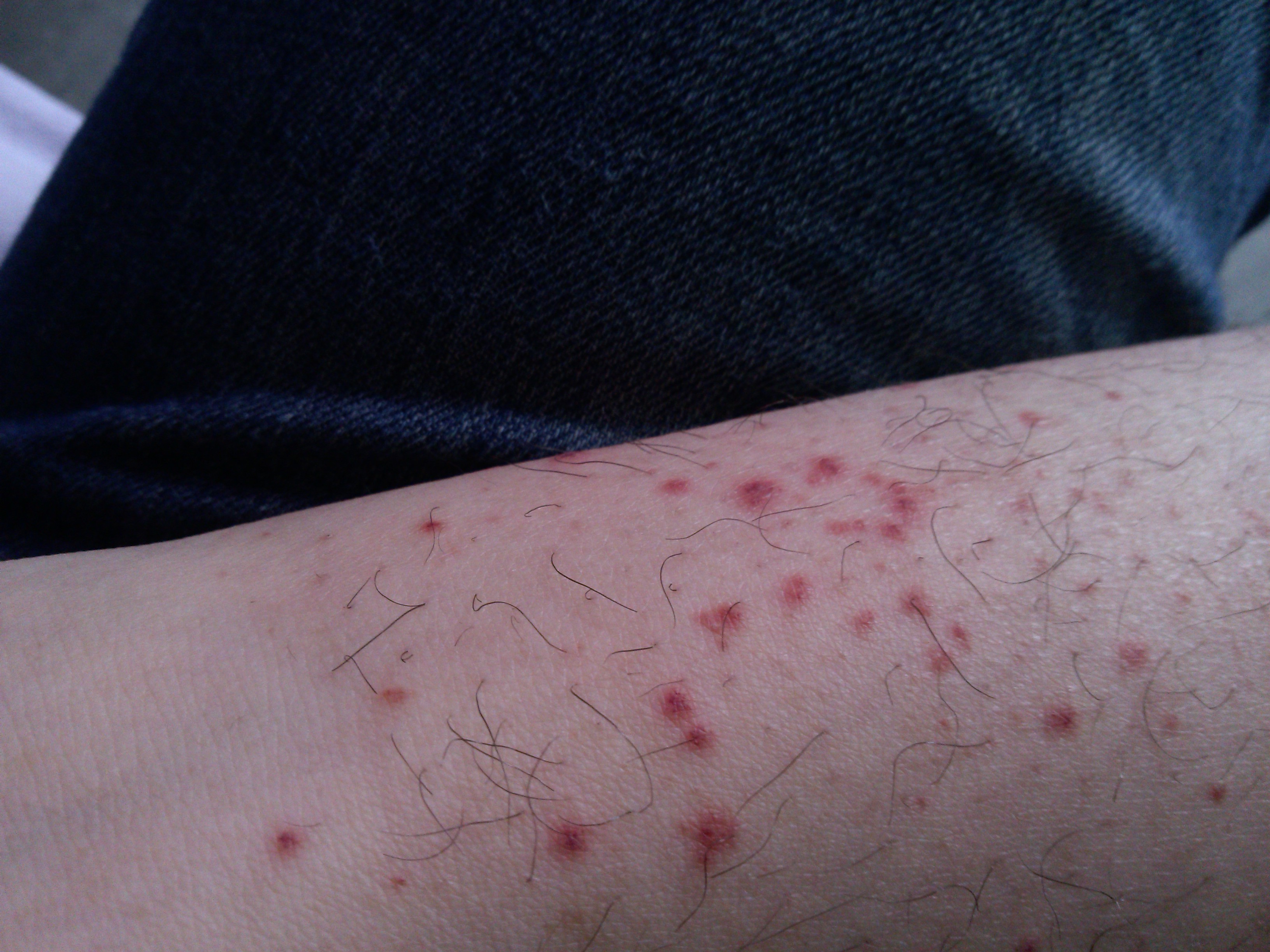 Plötzlich pusteln im gesicht und hals pickel löcher im gesicht entfernen