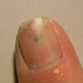 komischer Fingernagel?