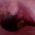Komisches "Ding" an der Mandel?