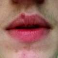 Pickel an Lippe was tun?