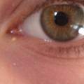 Pickel unter dem Auge? was ist das?