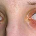 Rote Hautirritation unter dem Auge - HILFE