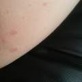 Rote pickel/pusteln im Intimbereich/ Innenschenkel