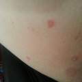 Rote pickel/pusteln im Intimbereich/ Innenschenkel