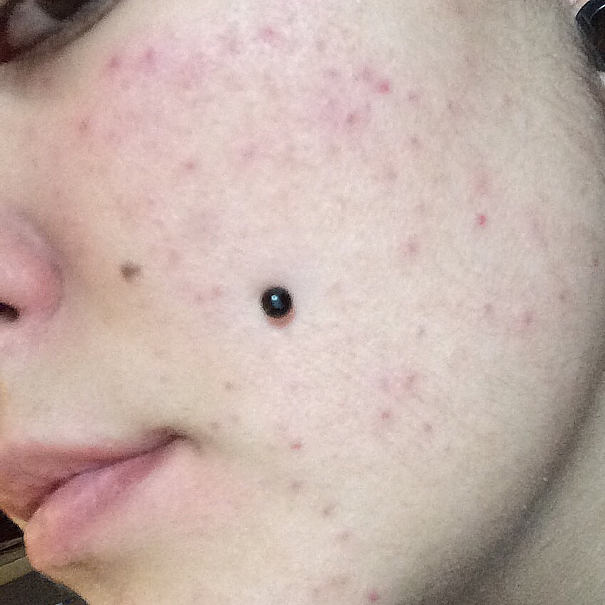 Pickel im gesicht nach geburt child 6 wochen pickel im gesicht