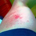 Rote, raue Flecken am Oberarm