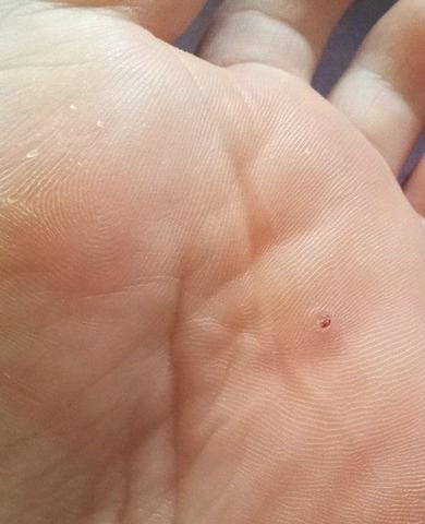 Der Schmerz auf dem Finger des Beines neben dem Nagel die Behandlung