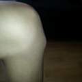 schmerzhafte erhebung am Knie