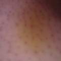 schwarze und rote Pickel auf den Beinen! Hilfe!!!